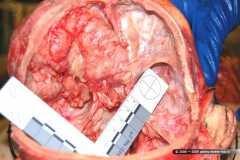 Hyperostosis